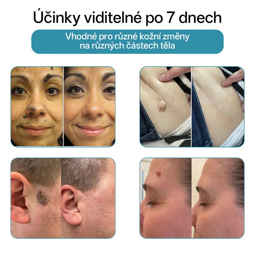 ✨ Bikenda® – CO₂ laserové pero na odstraňování 🟤 mateřských znamének, 🦠 bradavic, 🔘 skvrn a jiných nedokonalostí pleti💗