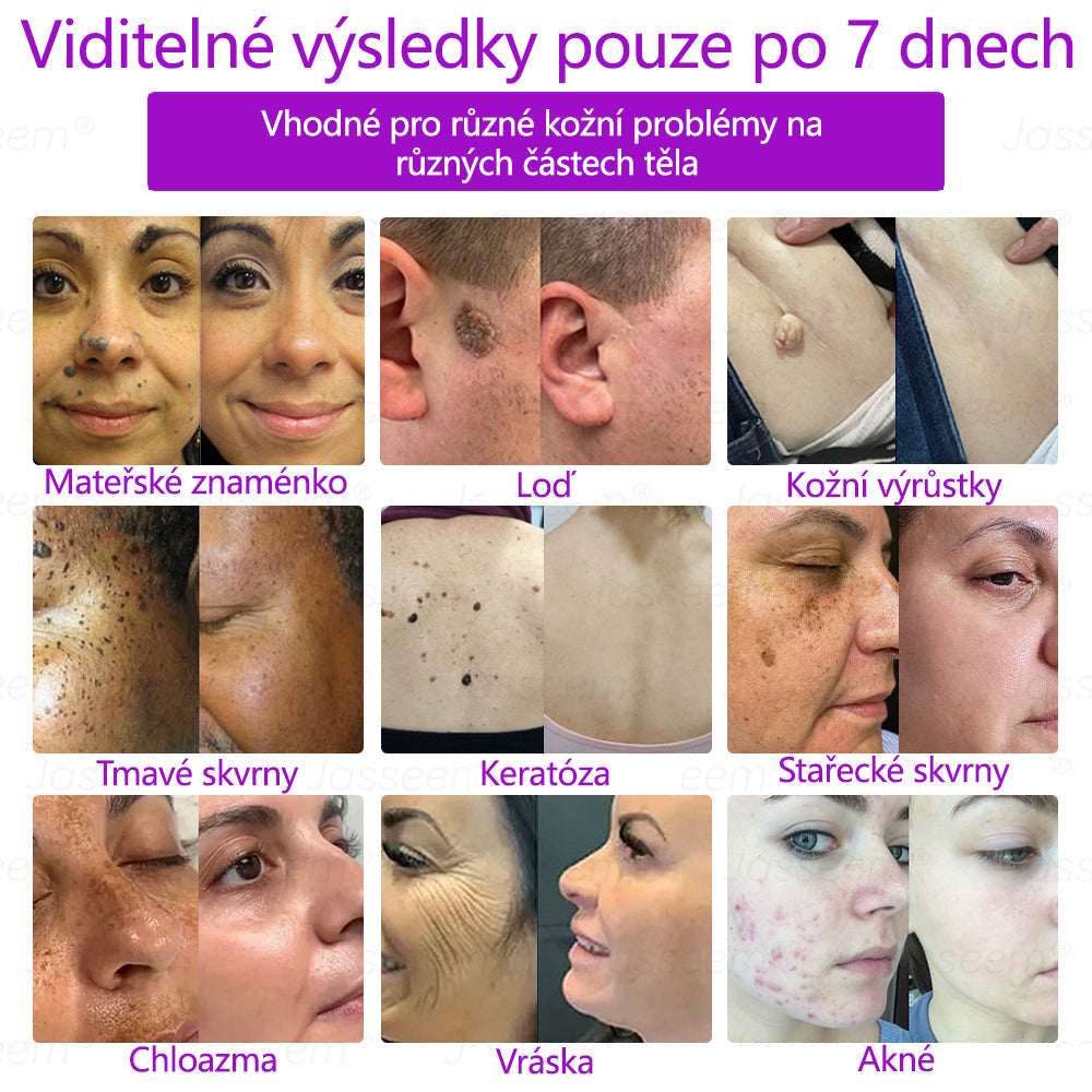 【Oficiální vlajkový obchod】𝐉𝐚𝐬𝐬𝐞𝐞𝐦® Pokročilé neinvazivní pero s CO₂ laserem na opravu pokožky 💕 (šetrně odstraňuje bradavice, mateřská znaménka, stařecké skvrny a kožní značky - bez bolesti a rozruchu!)💫
