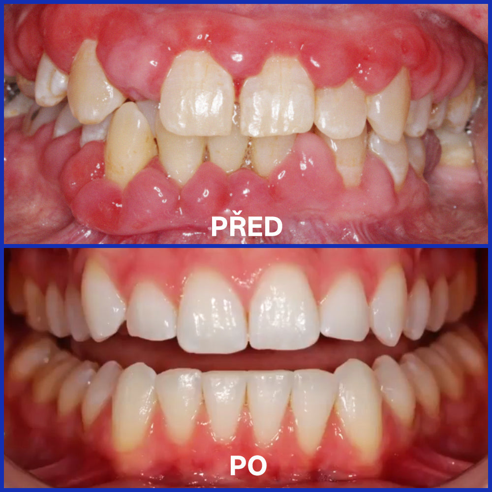 Furzero® Focusmile prášek s včelím jedem k perorálnímu užití 🦷