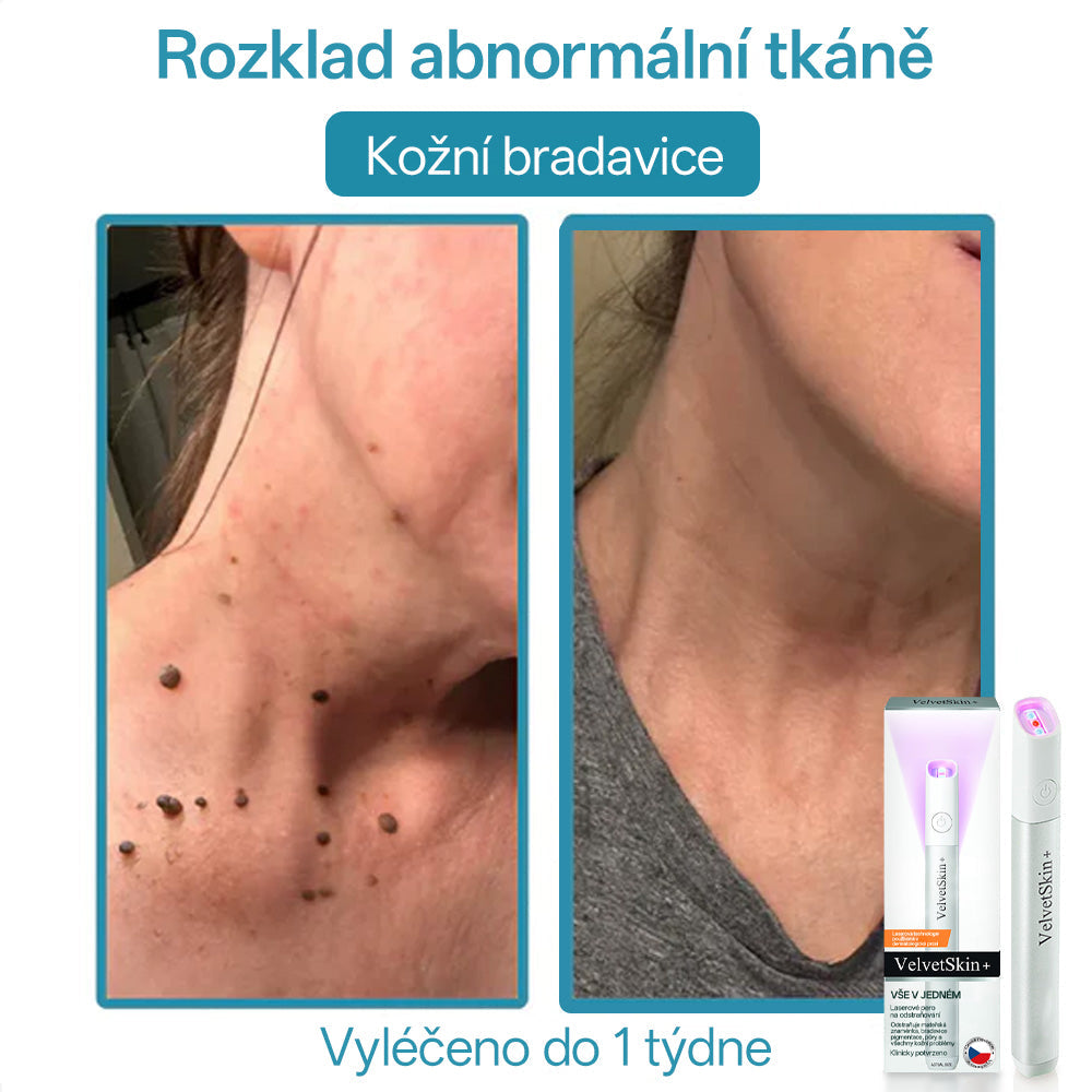 ✨ Bikenda® – CO₂ laserové pero na odstraňování 🟤 mateřských znamének, 🦠 bradavic, 🔘 skvrn a jiných nedokonalostí pleti💗