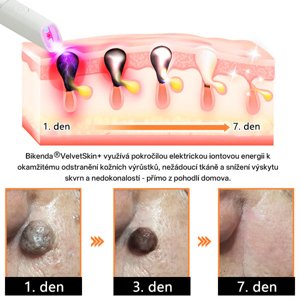 ✨ Bikenda® – CO₂ laserové pero na odstraňování 🟤 mateřských znamének, 🦠 bradavic, 🔘 skvrn a jiných nedokonalostí pleti💗