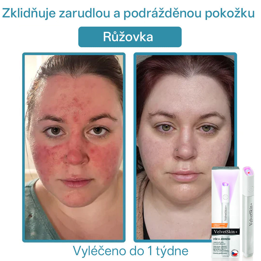 ✨ Bikenda® – CO₂ laserové pero na odstraňování 🟤 mateřských znamének, 🦠 bradavic, 🔘 skvrn a jiných nedokonalostí pleti💢