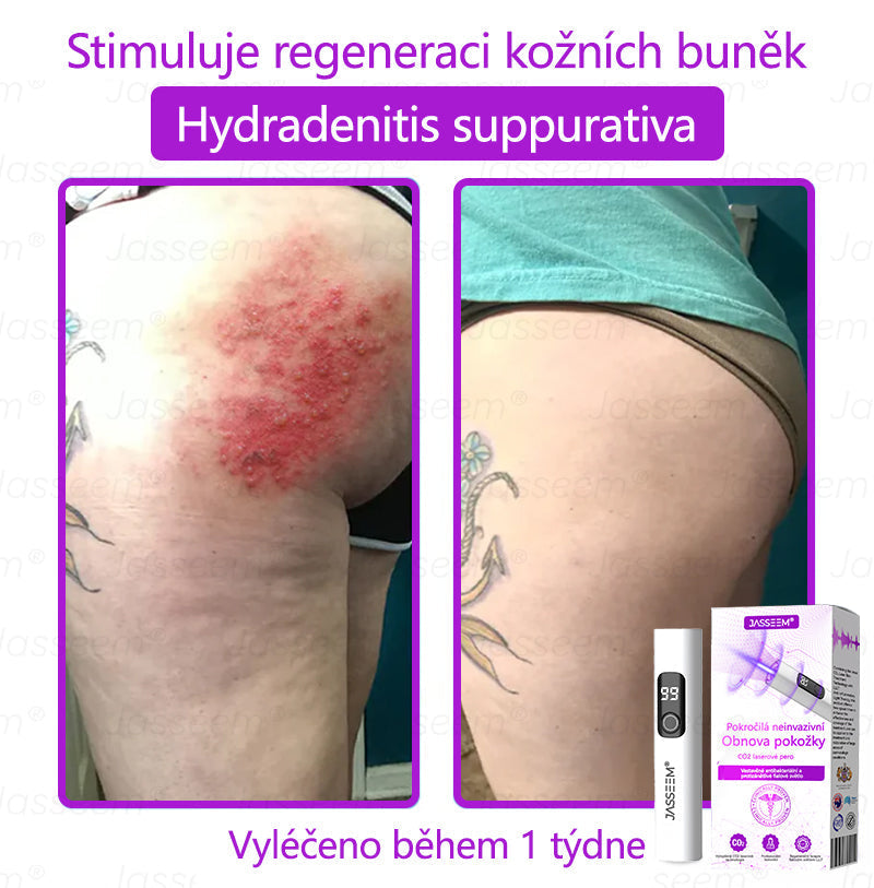 【Oficiální vlajkový obchod】𝐉𝐚𝐬𝐬𝐞𝐞𝐦® Pokročilé neinvazivní pero s CO₂ laserem na opravu pokožky 💕 (šetrně odstraňuje bradavice, mateřská znaménka, stařecké skvrny a kožní značky - bez bolesti a rozruchu!)💫