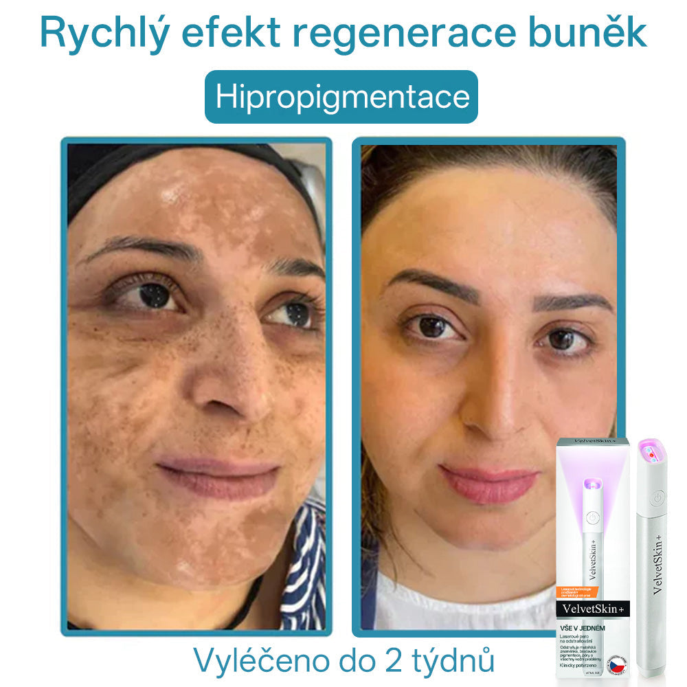 ✨ Bikenda® – CO₂ laserové pero na odstraňování 🟤 mateřských znamének, 🦠 bradavic, 🔘 skvrn a jiných nedokonalostí pleti💢