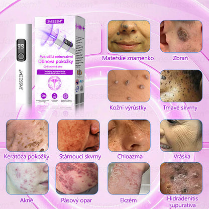 【Oficiální vlajkový obchod】𝐉𝐚𝐬𝐬𝐞𝐞𝐦® Pokročilé neinvazivní pero s CO₂ laserem na opravu pokožky 💕 (šetrně odstraňuje bradavice, mateřská znaménka, stařecké skvrny a kožní značky - bez bolesti a rozruchu!)💫