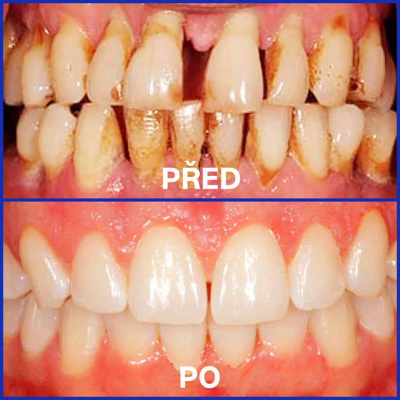 Furzero® Focusmile prášek s včelím jedem k perorálnímu užití 🦷