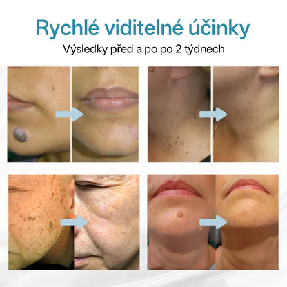 ✨ Bikenda® – CO₂ laserové pero na odstraňování 🟤 mateřských znamének, 🦠 bradavic, 🔘 skvrn a jiných nedokonalostí pleti💢