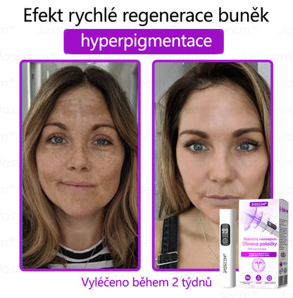 【Oficiální vlajkový obchod】𝐉𝐚𝐬𝐬𝐞𝐞𝐦® Pokročilé neinvazivní pero s CO₂ laserem na opravu pokožky 💕 (šetrně odstraňuje bradavice, mateřská znaménka, stařecké skvrny a kožní značky - bez bolesti a rozruchu!)💫