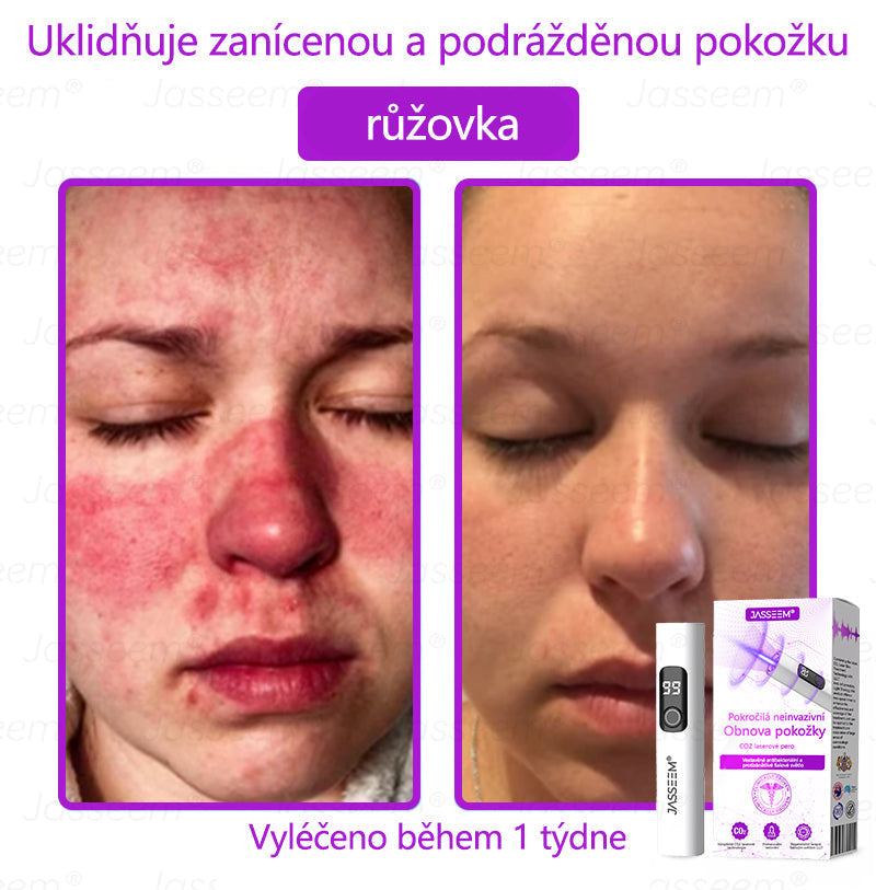 【Oficiální vlajkový obchod】𝐉𝐚𝐬𝐬𝐞𝐞𝐦® Pokročilé neinvazivní pero s CO₂ laserem na opravu pokožky 💕 (šetrně odstraňuje bradavice, mateřská znaménka, stařecké skvrny a kožní značky - bez bolesti a rozruchu!)💫