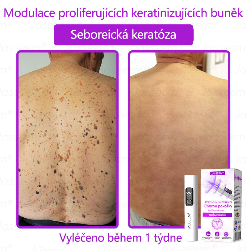 【Oficiální vlajkový obchod】𝐉𝐚𝐬𝐬𝐞𝐞𝐦® Pokročilé neinvazivní pero s CO₂ laserem na opravu pokožky 💕 (šetrně odstraňuje bradavice, mateřská znaménka, stařecké skvrny a kožní značky - bez bolesti a rozruchu!)💫