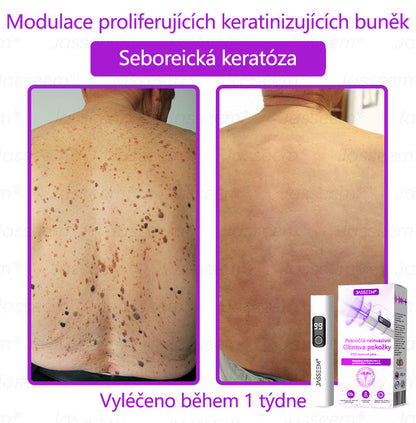 【Oficiální vlajkový obchod】𝐉𝐚𝐬𝐬𝐞𝐞𝐦® Pokročilé neinvazivní pero s CO₂ laserem na opravu pokožky 💕 (šetrně odstraňuje bradavice, mateřská znaménka, stařecké skvrny a kožní značky - bez bolesti a rozruchu!)💫