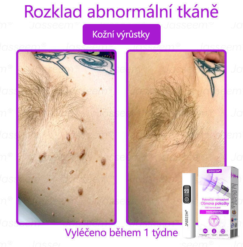 【Oficiální vlajkový obchod】𝐉𝐚𝐬𝐬𝐞𝐞𝐦® Pokročilé neinvazivní pero s CO₂ laserem na opravu pokožky 💕 (šetrně odstraňuje bradavice, mateřská znaménka, stařecké skvrny a kožní značky - bez bolesti a rozruchu!)💫