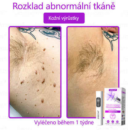 【Oficiální vlajkový obchod】𝐉𝐚𝐬𝐬𝐞𝐞𝐦® Pokročilé neinvazivní pero s CO₂ laserem na opravu pokožky 💕 (šetrně odstraňuje bradavice, mateřská znaménka, stařecké skvrny a kožní značky - bez bolesti a rozruchu!)💫
