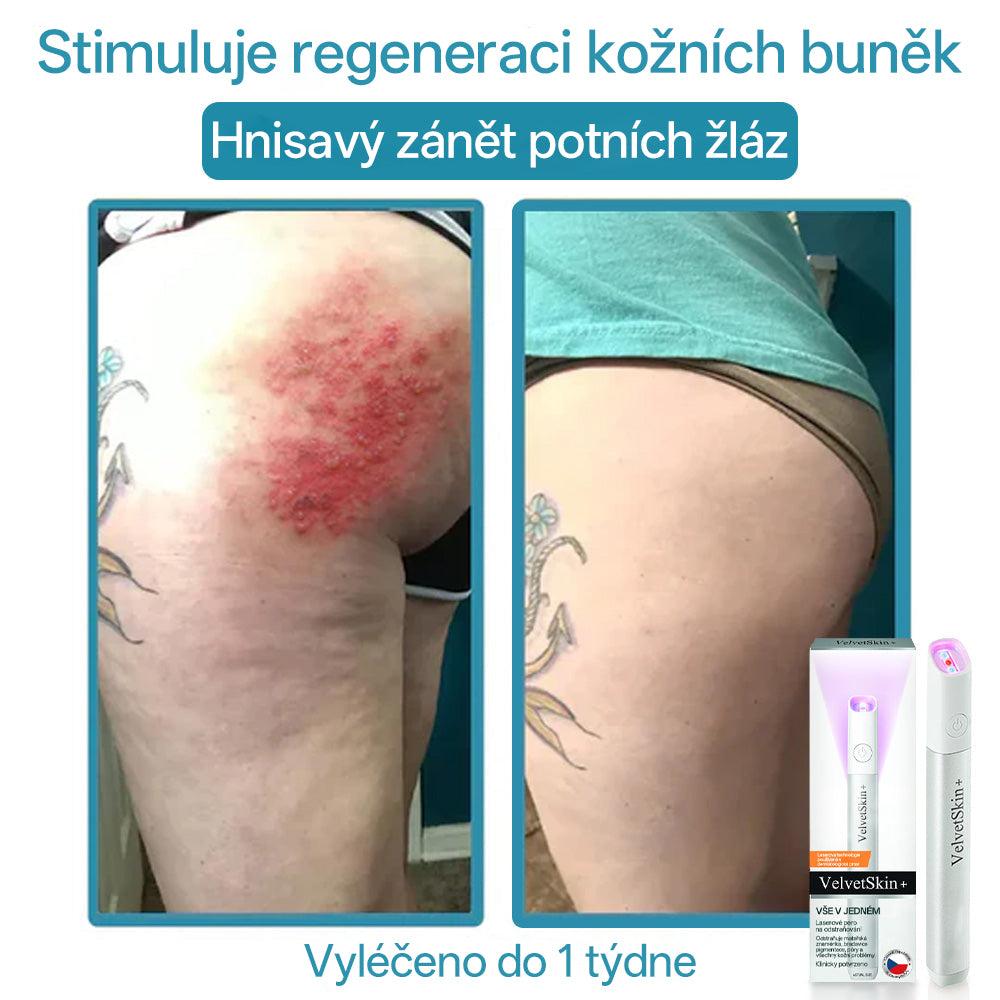 ✨ Bikenda® – CO₂ laserové pero na odstraňování 🟤 mateřských znamének, 🦠 bradavic, 🔘 skvrn a jiných nedokonalostí pleti💢