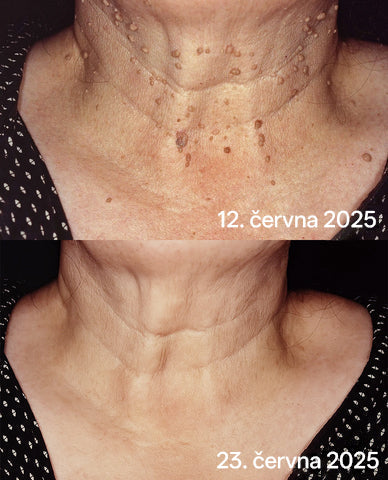 ✨ Bikenda® – CO₂ laserové pero na odstraňování 🟤 mateřských znamének, 🦠 bradavic, 🔘 skvrn a jiných nedokonalostí pleti💢